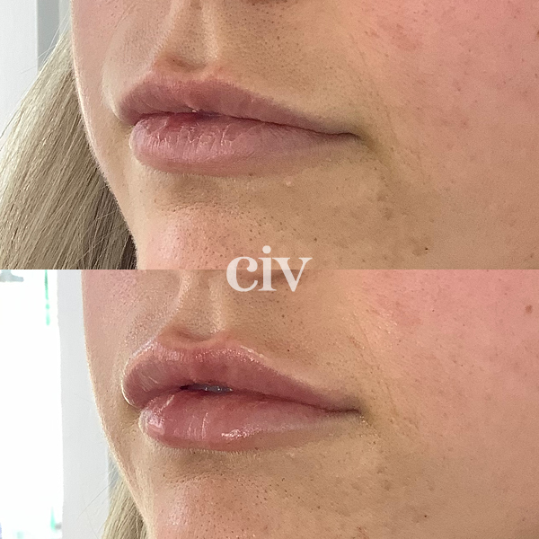 lipfillers_1