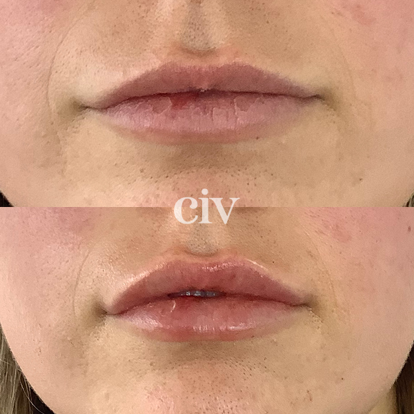 lipfillers_2