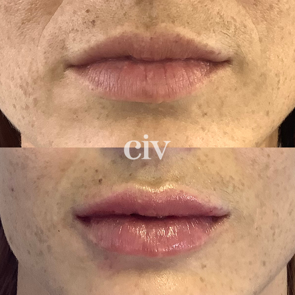 lipfillers_3